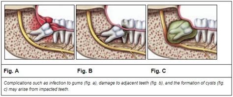 Common Problems Caused By Wisdom Teeth Center City Emergency Dentist