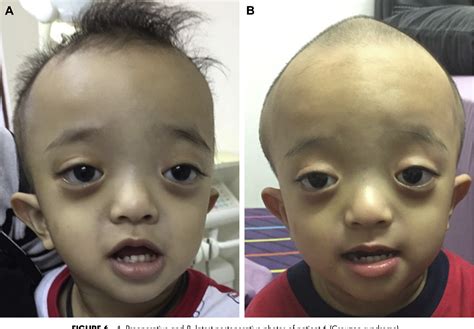 Figure 6 from Crouzon Syndrome: A Case Series of Craniomaxillofacial Distraction Osteogenesis ...