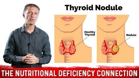 Whats Behind Thyroid Nodules