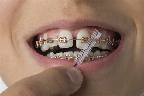 Traditional Braces In Richardson Texas Pros Cons Cost