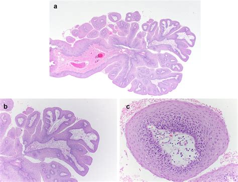 Histologic Features Of Squamous Papilloma A The Exophytic Nature Is Download Scientific