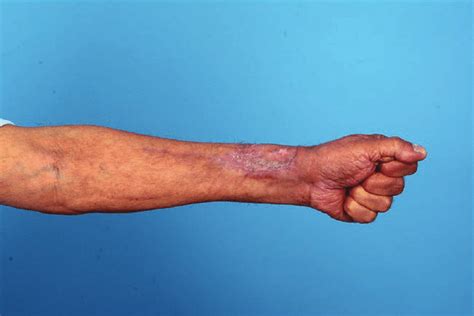 Skin Grafted Radial Forearm Flap Donor Site 2 Months After Surgery