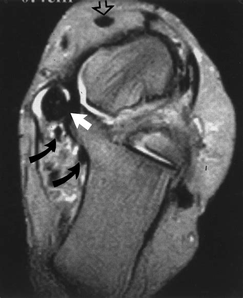 Mr Imaging Of Disorders Of The Posterior Tibialis Tendon Ajr