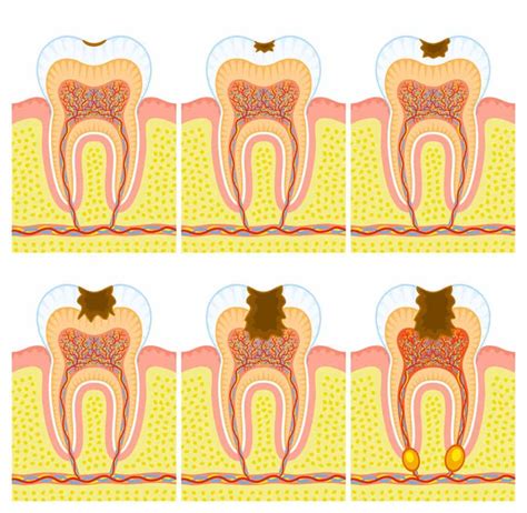 Stages Of Tooth Decay Wellness Biodentistry