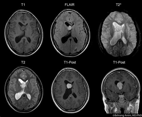 Roentgen Ray Reader Subependymal Giant Cell Astrocytoma
