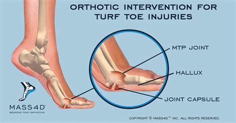 How An Orthotic Intervention Can Help Treat Turf Toe Injuries Mass4d