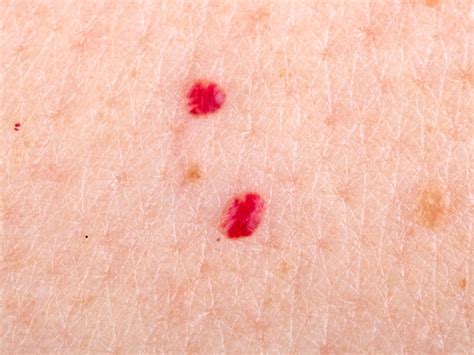 What Are Red Moles And Are They Dangerous First For Women