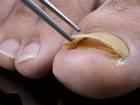 Toenail Falling Off What To Do Causes And Removal