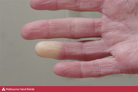 Raynauds Disease Cold White Fingers Melbourne Hand Rehab
