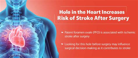 Hole In The Heart Increases Risk For Stroke After Surgery