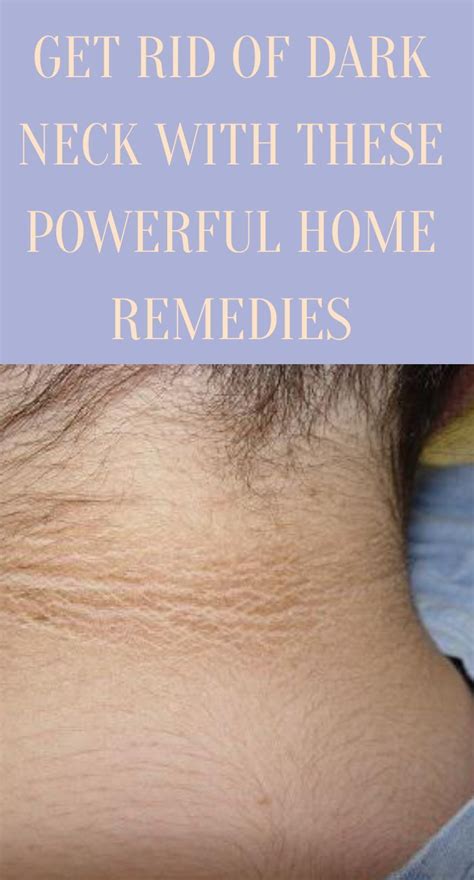 Get Rid Of Dark Neck With These Powerful Home Remedies Natural