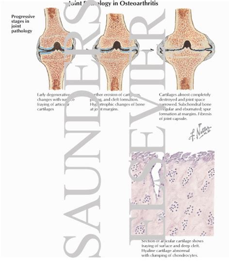 Joint Pathology In Osteoarthritis