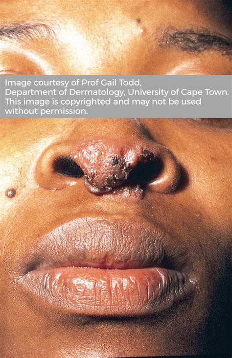 Cutaneous Tuberculosis University Of Cape Town