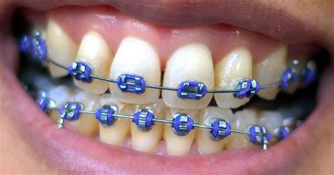 Braces 101 All About Orthodontia