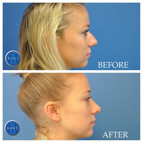 Make Your Nose Your Best Feature Rhinoplasty At Mbody