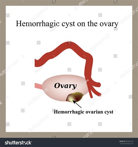 Hemorrhagic Cyst On Ovary Ovary Infographics เวกเตอร์สต็อก ปลอดค่า