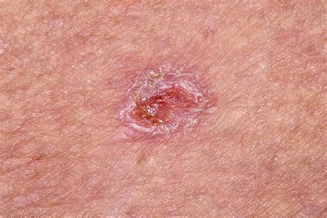 Basal Cell Skin Cancer Face