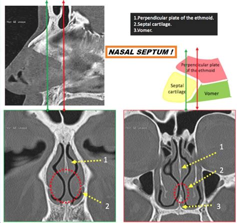 Nasal Septum Radiology Imaging Radiology Nervous System Anatomy