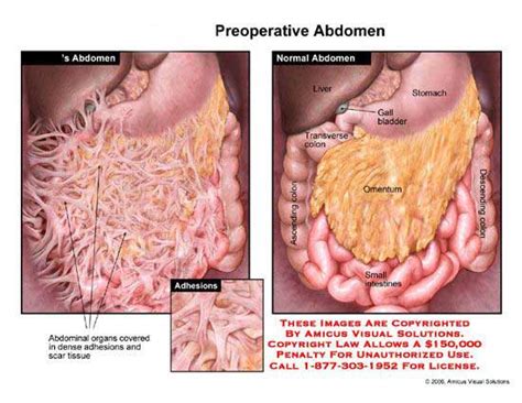Internal Abdominal Scar Tissue Symptoms