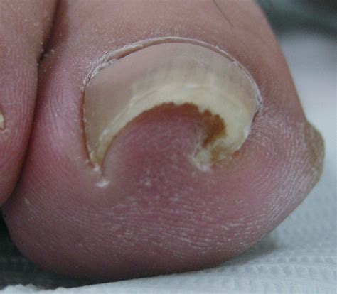 Typical Appearance Of Pincer Nail Transverse Overcurvature Of The Nail