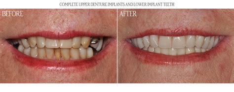 Before And After Gallery Asird American Society Of Implant And