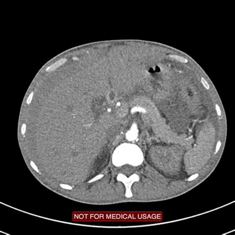 Post Liver Biopsy Haemorrhage Radiology Case