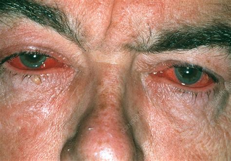 Viral Conjunctivitis Stock Image M1550440 Science