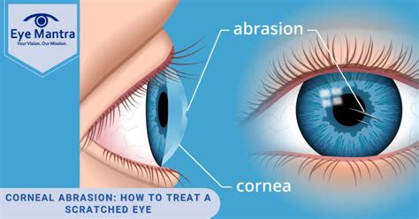 Corneal Abrasion How To Treat A Scratched Eye Eyemantra Hospital