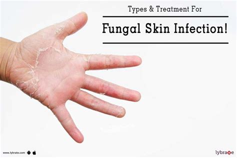 Types And Treatment For Fungal Skin Infection By Dr Anup Kumar Tiwary