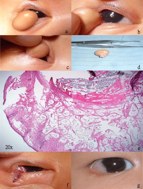 Clinical And Histopathological Manifestation Of Complex Choristoma A