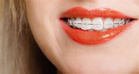 Peut On Faire De La Boxe Avec Un Appareil Dentaire - 5 conseils pour blanchir vos dents si vous portez des bagues ou un