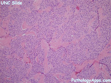 Myoepithelioma Pathology