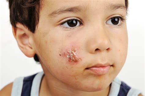 School Sores Symptoms And Treatment Of Impetigo Qoctor Your Online Doctor