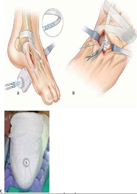Anterior Tibialis Transfer For Residual Clubfoot Deformity Pediatrics Operative Techniques