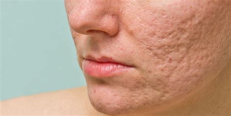 How To Treat Acne Scars Dermatologist Dr Nivedita Dadu Shares Tips