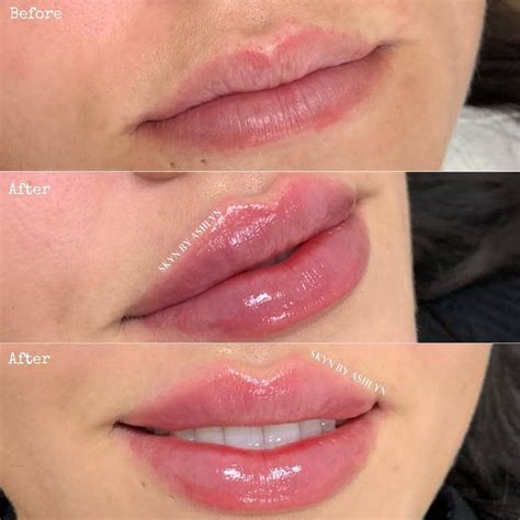 Best Of Cosmetic Dermatology On Instagram “beforeafter Lip Filler