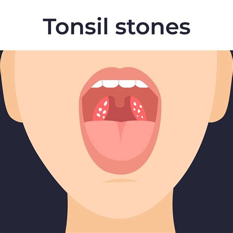 Do You Have Tonsil Stones Causes Symptoms And Treatments With Puyallup