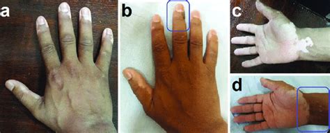 A Periungual And C Wrist Lesions In A Stable Vitiligo Case Download Scientific Diagram