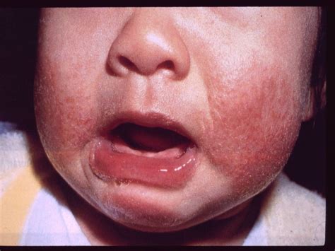 Eczema In Children Atopic Dermatitis In Children Causes Triggers