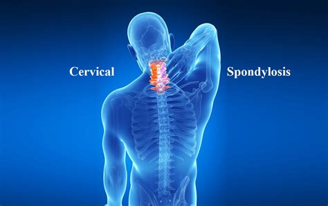 Cervical Spondylosis Symtoms Causes And Remedies Infodrishti