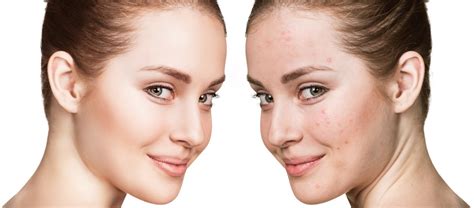 Top 10 Best Acne Treatments Cosmetic Laser Centers Blog