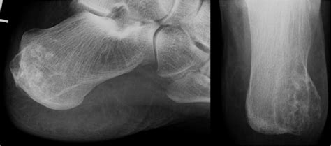 Low Grade Chondrosarcoma G1 Of The Left Calcaneus In A 46 Years Old