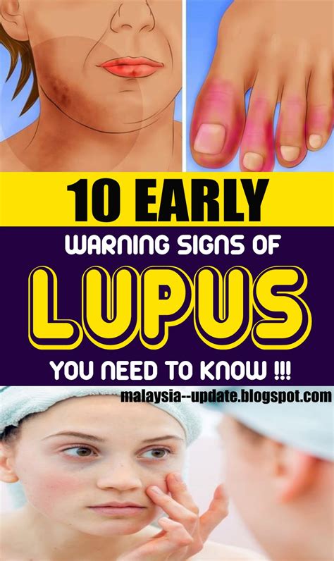 10 Early Warning Signs Of Lupus You Need To Know Healthy Living