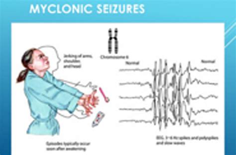 Myoclonic Seizure