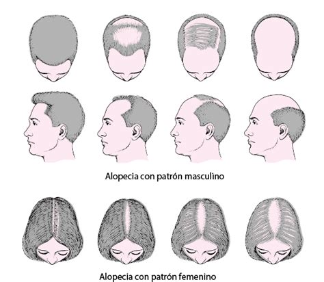 Figure Patrones Masculino Y Femenino De Pérdida Del Cabello Alopecia