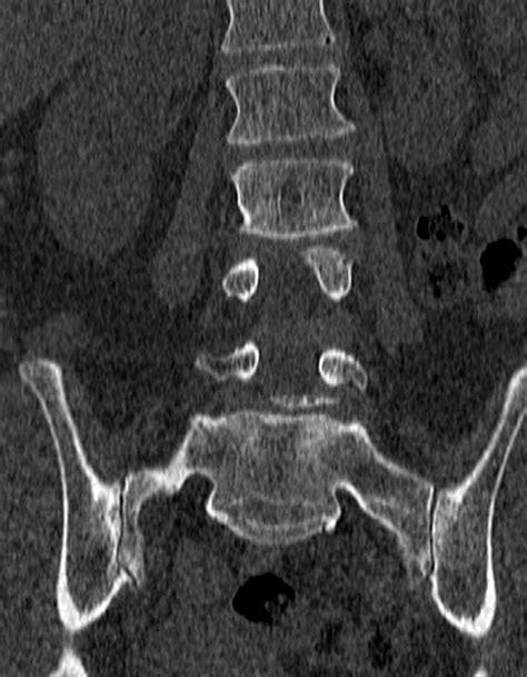 Sacralization Of L5 Image Radiopaedia Org