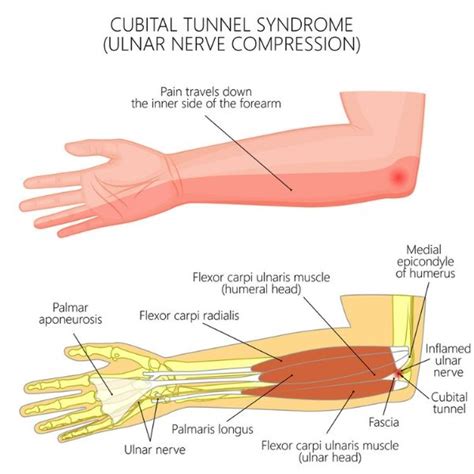 Ulnar Nerve Entrapment Pain