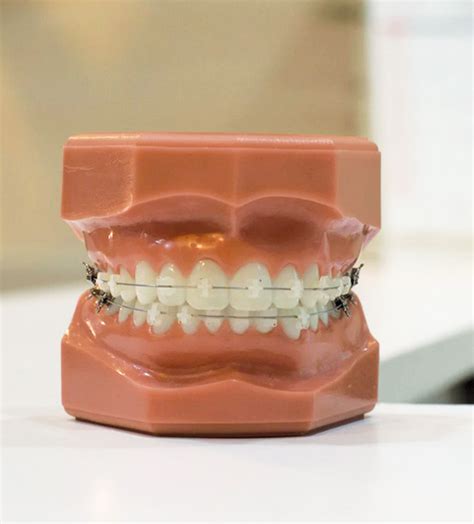 Clear Braces Discreet Ceramic Braces Bachmayer Orthodontic Clinic