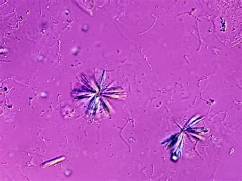 Спирали куршмана и кристаллы шарко-лейдена. Кристаллы в мокроте. Микроскопия мокроты кристаллы гематоидина. Кристаллы гематоидина в мокроте под микроскопом. Кристаллы в мокроте.