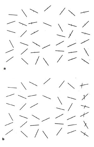 The schenkenberg line bisection test (schenkenberg, bradford, & ajax, 1980), for example, consists of 20 lines of different sizes that are centered to either the left, right, or middle of a page. Gaumstol - Yfirlit - Einkenni, tíðni, greining og horfur | 10. tbl 93. árg. 2007 | Læknablaðið